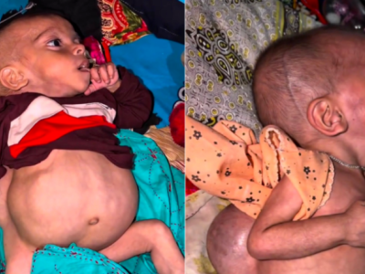 Urgent Help Needed: Save Helpless Little Ayaan Fighting a Deadly Tumor — Please Help!